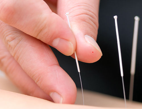 Dry Needling